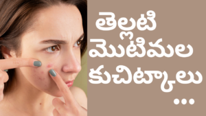 Face White Pimples In Telugu